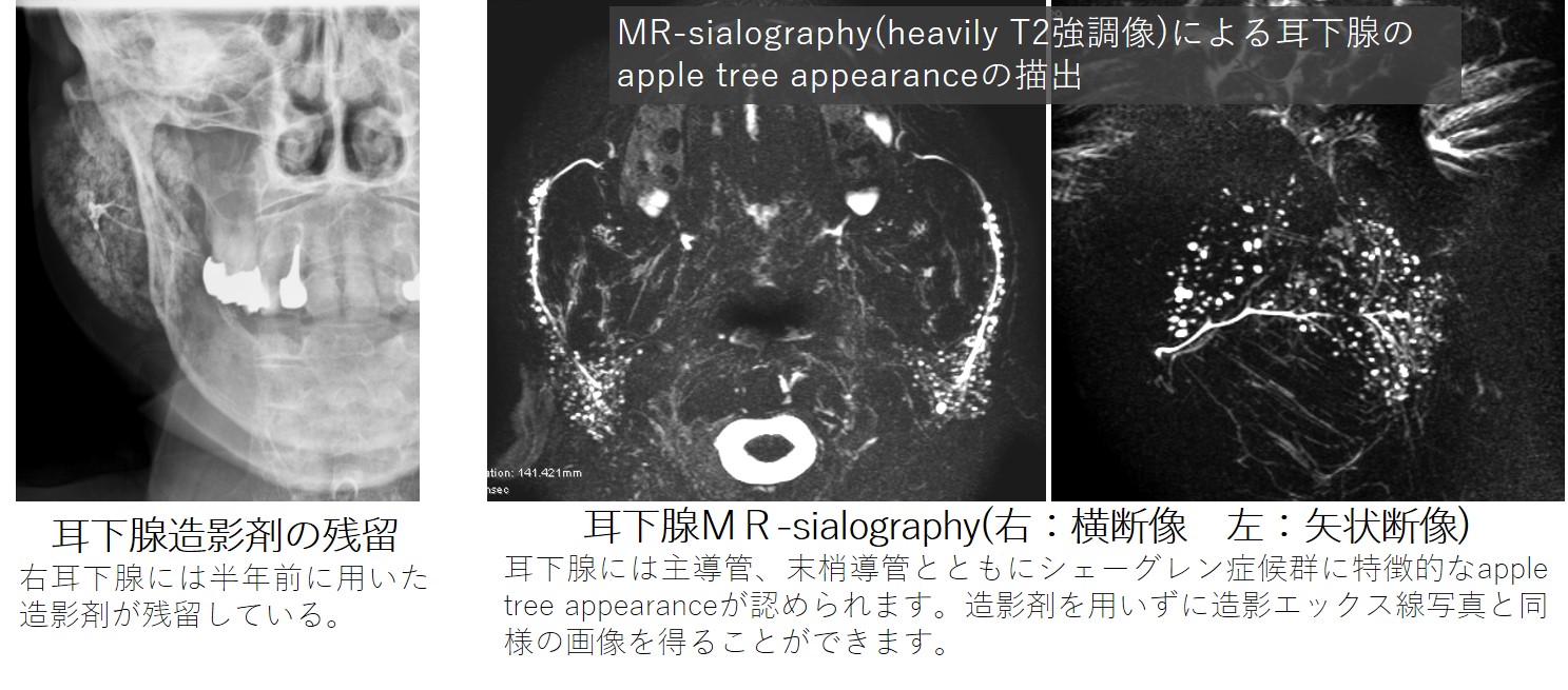 研究紹介：MRI 東北大 歯科医用情報学分野 顎口腔画像診断科